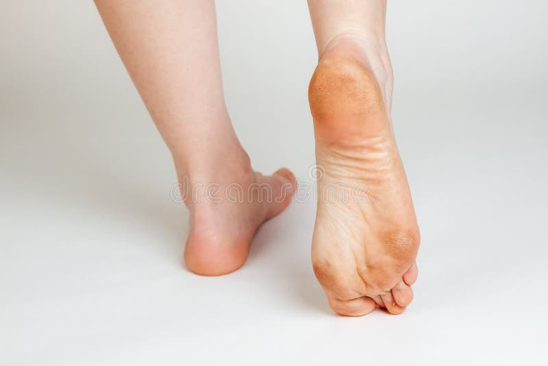 Female feet with corns and calluses, on a white background. Foot close-up. Cosmetology and medicine