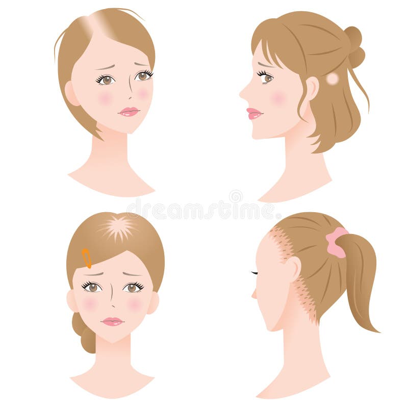 Female hair loss stock illustration Female hair loss stock illustration