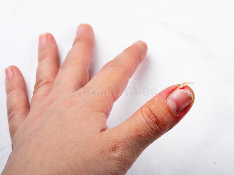 429 Finger Skin Peeling Stock Photos, High-Res Pictures, and Images - Getty  Images