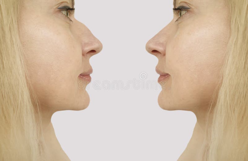 Female Humpback Nose before and after Problem Treatment Stock Photo - Image of correction, background: 184236134 Female Humpback Nose before and after Problem Treatment Stock Photo - Image of correction, background: 184236134