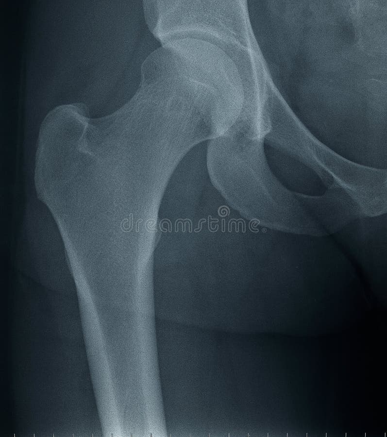 Female Left Hip XRay stock photo. Image of medicine 72038664