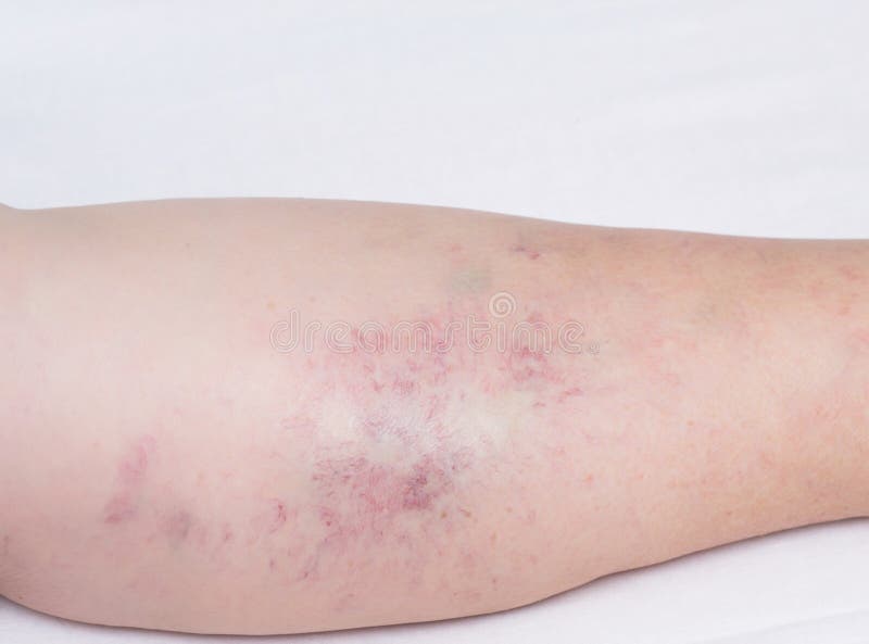 varicose capilary ceea ce ajuta la varicoza foarte puternica