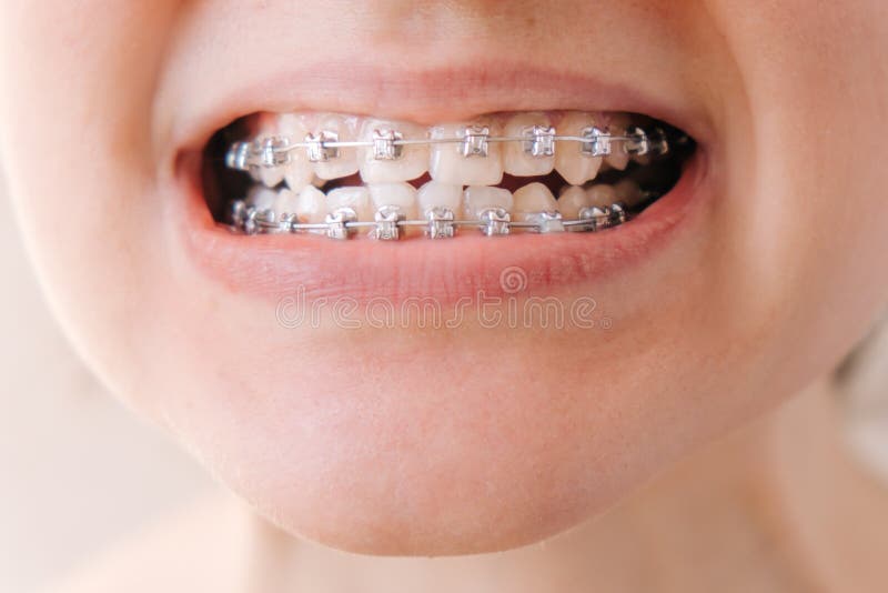 Female mouth with braces close-up, correction of malocclusion stock photography Female mouth with braces close-up, correction of malocclusion stock photography