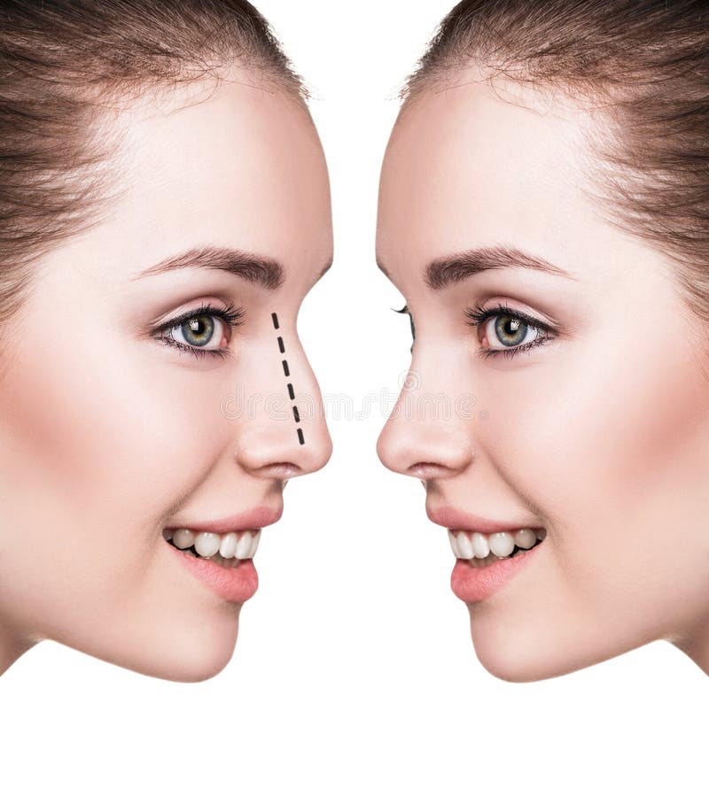 Female nose before and after cosmetic surgery stock images 