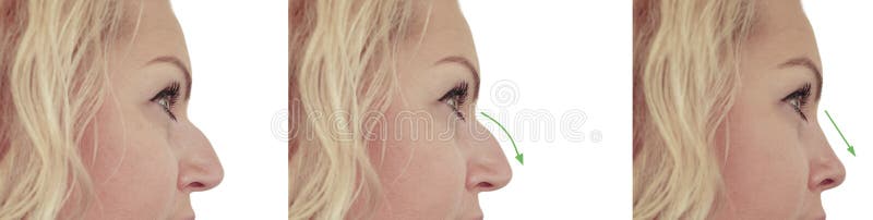 Female Nose Hump before and after Procedures Problem Stock Image - Image of  facial, correction: 141894313