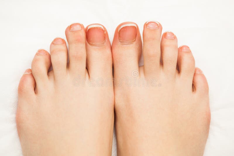 Female Toe Nails without Pedicure. Lack of Nutrients. Close-up View. No  Face. Stock Image - Image of long, polish: 112016513