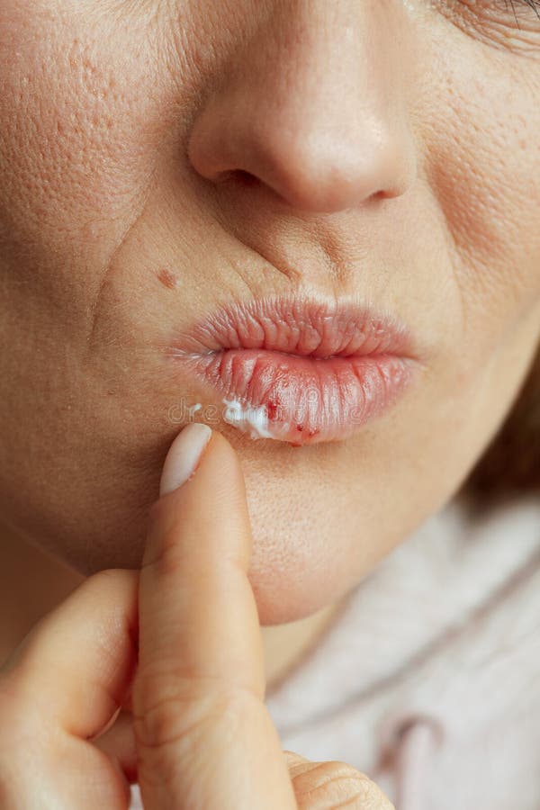 Femelle appliquant un onguent en utilisant le doigt sur beige. Fermer sur la femelle avec herpès sur les lèvres appliquer onguent avec doigt sur fond beige