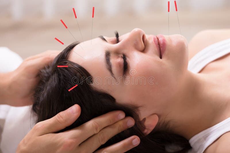 Femme recevant le traitement d'acuponcture photographie stock libre de droits Femme recevant le traitement d'acuponcture photographie stock libre de droits