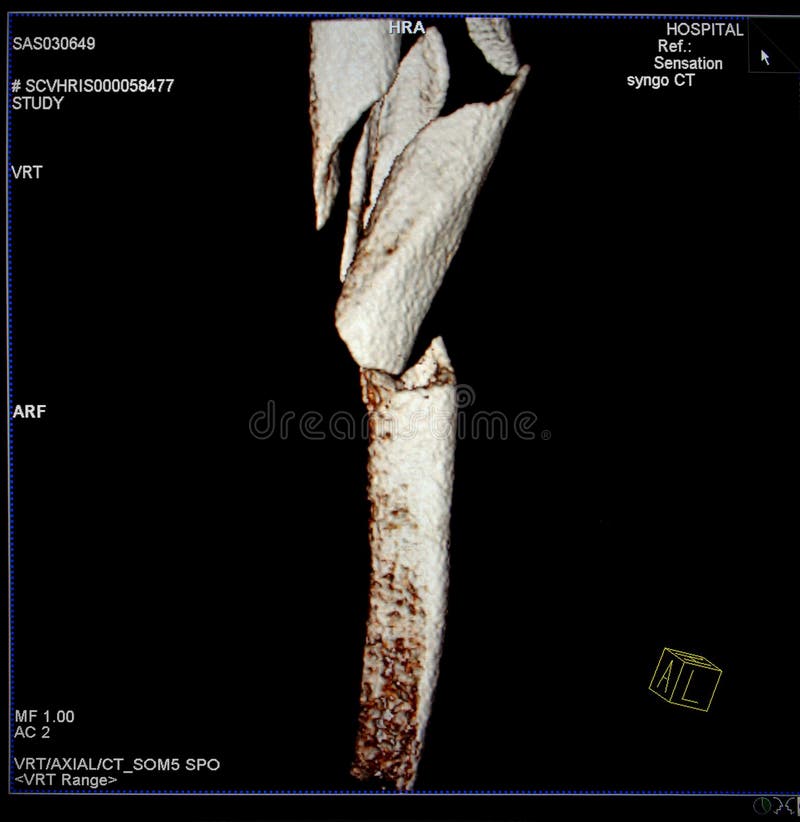 Femur fracture, Modern CT-scan reconstruction.