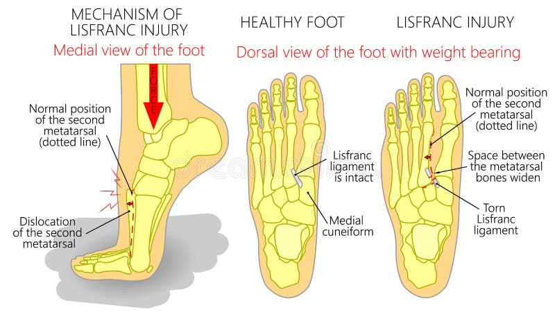 Vector illustration of a healthy human foot and a foot with lisfranc injury with weight bearing and mechanism of injury, dislocation of the second metatarsal bone. Medial, top view of the foot. EPS 10. Vector illustration of a healthy human foot and a foot with lisfranc injury with weight bearing and mechanism of injury, dislocation of the second metatarsal bone. Medial, top view of the foot. EPS 10