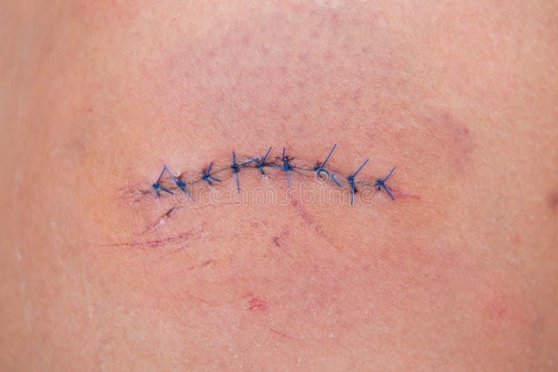 Ferita Dopo Intervento Stenosi Lombare Ferita Chirurgica Sul Corpo Dopo Il Pronto Soccorso Di Rivestimento
