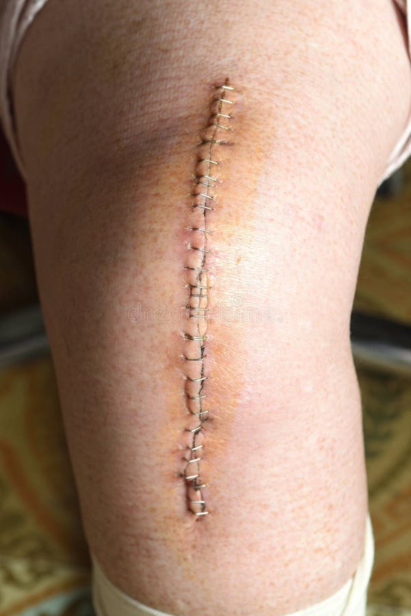 Ferita Dopo Intervento Stenosi Lombare Sfregi Sul Ginocchio Di Una Donna Senior, Fotografia Stock - Immagine