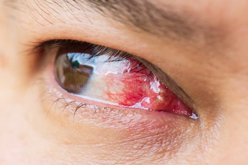 Fermez-vous du pterygium au cours de l'examen d'oeil images libres de droits Fermez-vous du pterygium au cours de l'examen d'oeil images libres de droits