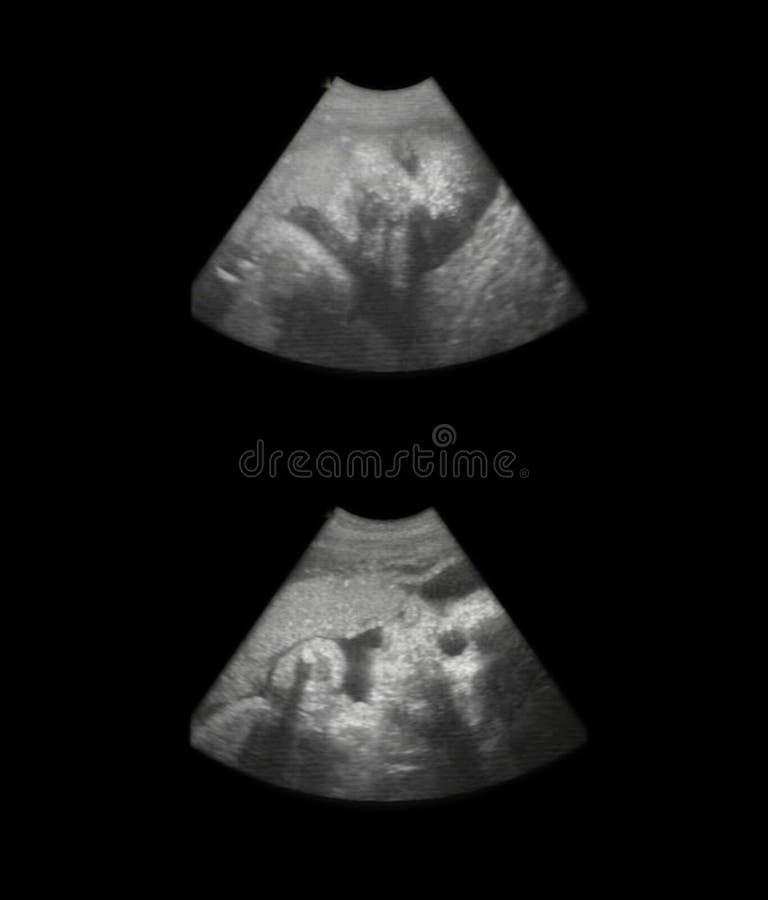 Fetus sonogram - 8 month