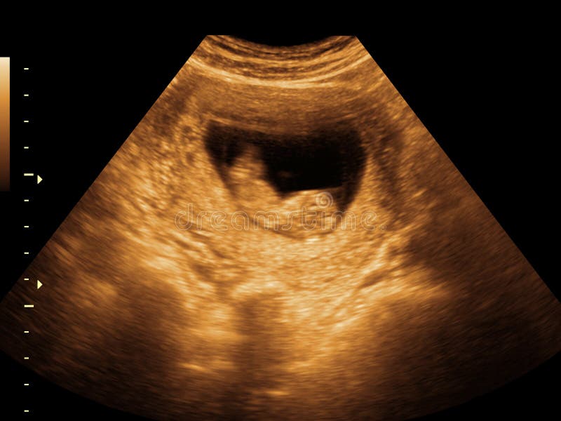 3 390 Fetus Ultrasound Photos Free Royalty Free Stock Photos From Dreamstime 3 390 Fetus Ultrasound Photos Free Royalty Free Stock Photos From Dreamstime
