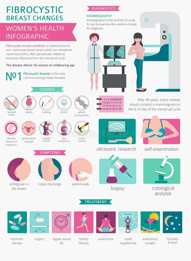 Fibrocystic borst verandert ziekte, medische infographic Diagnos vector illustratie Fibrocystic borst verandert ziekte, medische infographic Diagnos vector illustratie