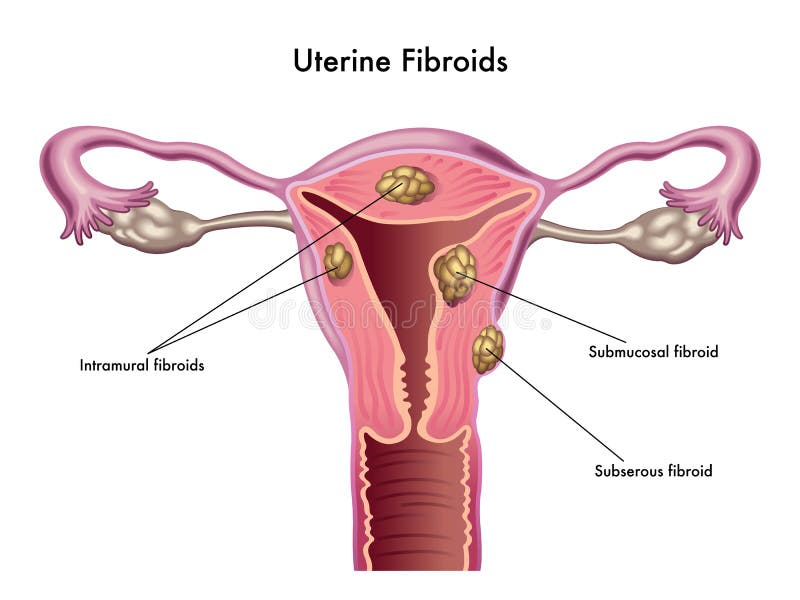 Fibroids Uterine ilustração stock
