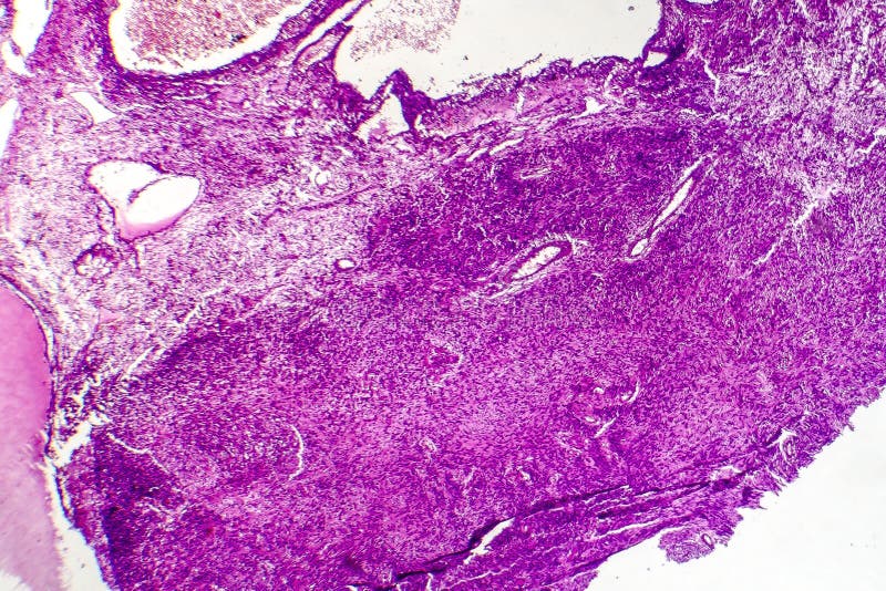 Fibrosarcoma elakartad tumör av fibroblasts royaltyfria foton Fibrosarcoma elakartad tumör av fibroblasts royaltyfria foton