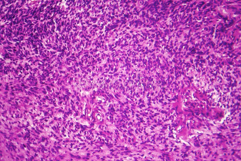 Fibrosarcoma elakartad tumör av fibroblasts royaltyfri fotografi Fibrosarcoma elakartad tumör av fibroblasts royaltyfri fotografi