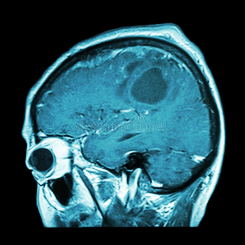 Film MRI mozgu s nádorom mozgu ( Sagittal rovine , bočné okne bočného pohľadu), (Zdravotnú , starostlivosť o Zdravie , Veda Pozadí )