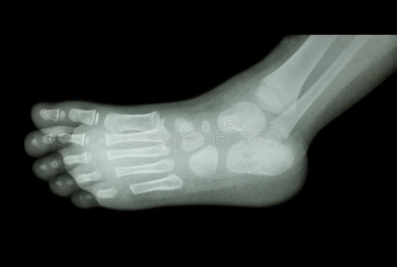Film Xray of Child S Foot ( Side View ) ( Lateral ) Stock Image Image of heel, lateral 58744591