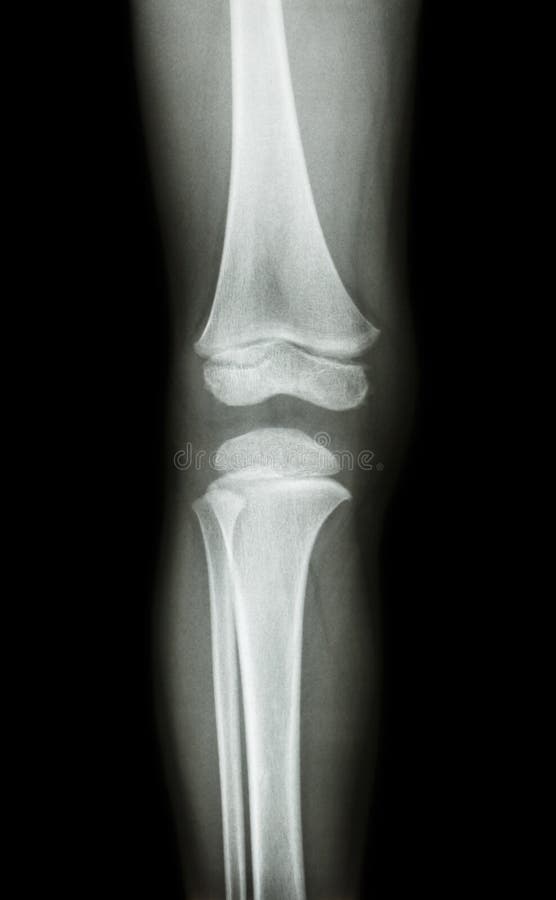 Film x-ray knee AP(antero-posterior) of child royalty free stock photography Film x-ray knee AP(antero-posterior) of child royalty free stock photography