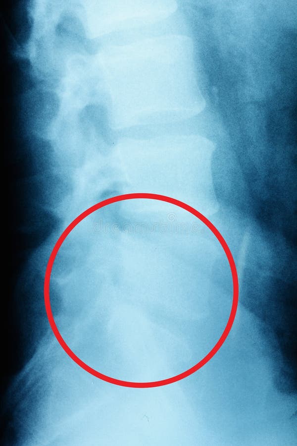 Film x-ray lumbar spine , L-S spine AP,Lateral view Grade spondylolithesis of L5-S1 , Decresed height of intervertebral disc space stock image Film x-ray lumbar spine , L-S spine AP,Lateral view Grade spondylolithesis of L5-S1 , Decresed height of intervertebral disc space stock image