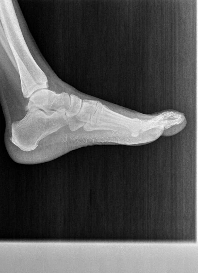 Film Xray Or Radiograph Of A Normal Foot Ankle And Leg Lateral View film-xray-or-radiograph-of-a-normal-foot-ankle-and-leg-lateral-view