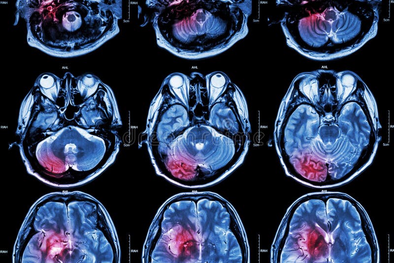 Filma MRI (kopiering för magnetisk resonans) av hjärnan (slaglängden, hjärntumöret, cerebral infarkt, den intracerebral blödninge fotografering för bildbyråer Filma MRI (kopiering för magnetisk resonans) av hjärnan (slaglängden, hjärntumöret, cerebral infarkt, den intracerebral blödninge fotografering för bildbyråer