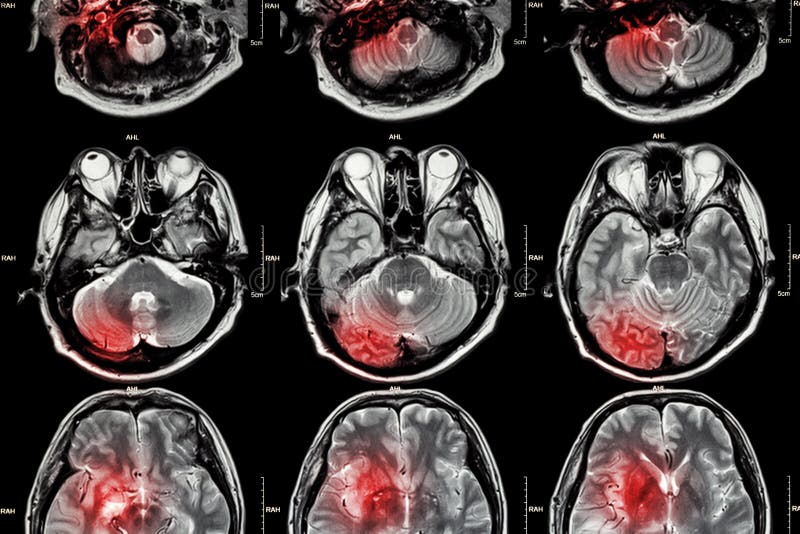 Filma MRI (kopiering för magnetisk resonans) av hjärnan (slaglängden, hjärntumöret, cerebral infarkt, den intracerebral blödninge arkivfoto Filma MRI (kopiering för magnetisk resonans) av hjärnan (slaglängden, hjärntumöret, cerebral infarkt, den intracerebral blödninge arkivfoto