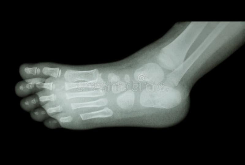 Film x-ray of child's foot ( side view ) ( lateral ). Film x-ray of child's foot ( side view ) ( lateral )