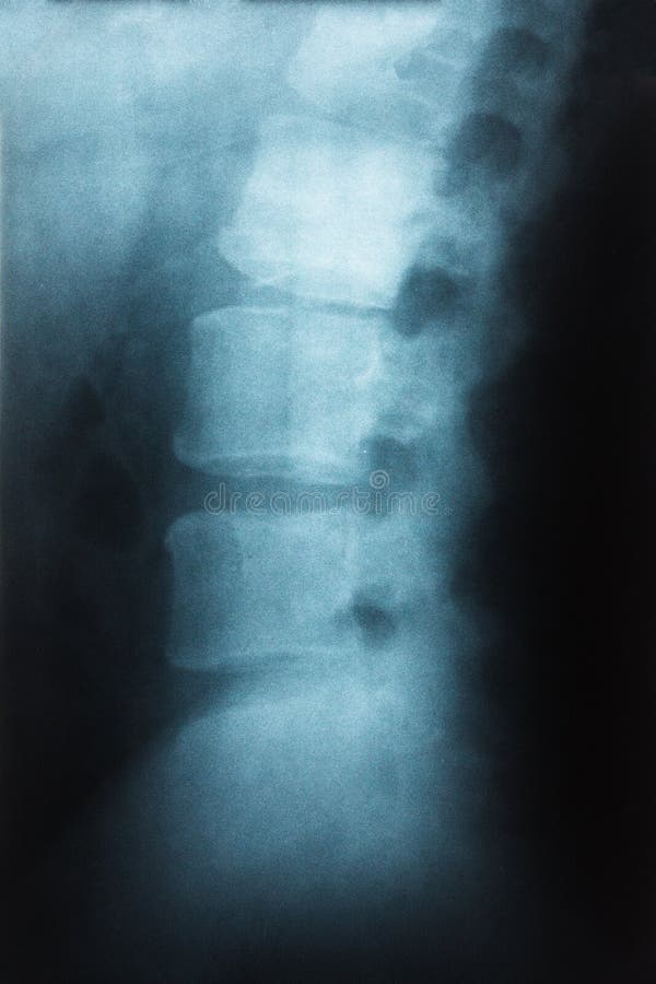 Filmen Sie lumbalen Dorn des Röntgenstrahls, L-Sdorn AP, Seitenansicht-Grad spondylolithesis von L5-S1, Decresed-Höhe des Zwische stockfoto Filmen Sie lumbalen Dorn des Röntgenstrahls, L-Sdorn AP, Seitenansicht-Grad spondylolithesis von L5-S1, Decresed-Höhe des Zwische stockfoto