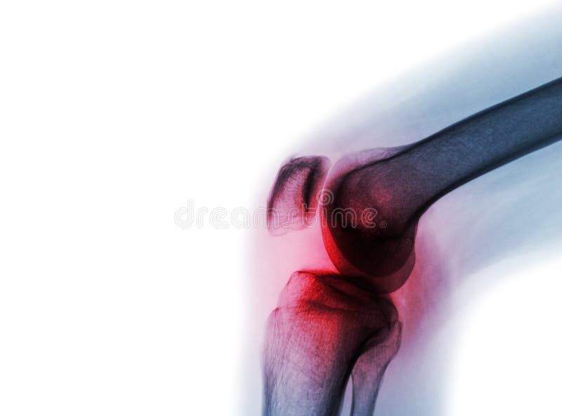Filmez l'articulation du genou de rayon X avec l'arthrite et le x28 ; Goutte, rhumatisme articulaire, arthrite septique, genou d' images stock Filmez l'articulation du genou de rayon X avec l'arthrite et le x28 ; Goutte, rhumatisme articulaire, arthrite septique, genou d' images stock