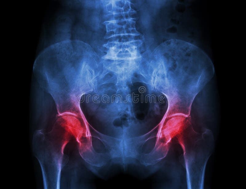 Filmez le bassin de rayon X du patient et de l'arthrite d'ostéoporose les deux hanche photo stock Filmez le bassin de rayon X du patient et de l'arthrite d'ostéoporose les deux hanche photo stock