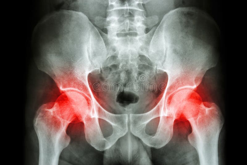 Filmi il bacino e l'artrite dell'essere umano dei raggi x agli entrambi articolazione dell'anca (gotta, reumatoidi)