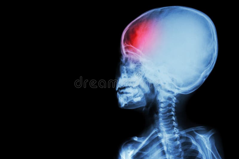 Filmröntgenstrålekropp av barnet och huvudvärken ((den isolerade) hjärnsjukdomen)