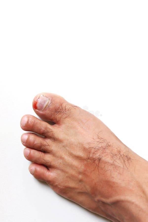 Finden Sie den Nagel, Unfallnageltrauma, Blutungszehennägel, Fußgeschwüre herausfinden einen Nagel, Onychocryptosis heraus stockfoto Finden Sie den Nagel, Unfallnageltrauma, Blutungszehennägel, Fußgeschwüre herausfinden einen Nagel, Onychocryptosis heraus stockfoto