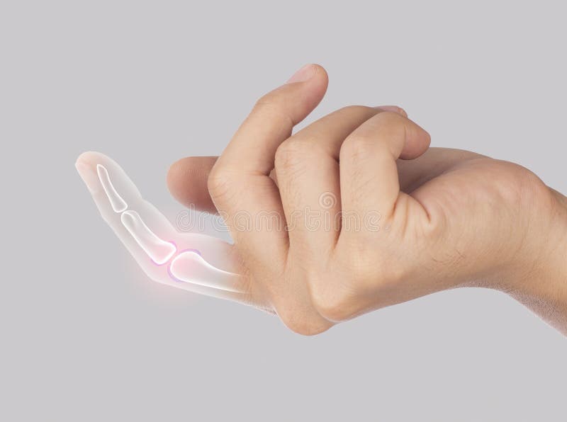 251 Brittle Bone Disease Stock Photos Free & RoyaltyFree Stock