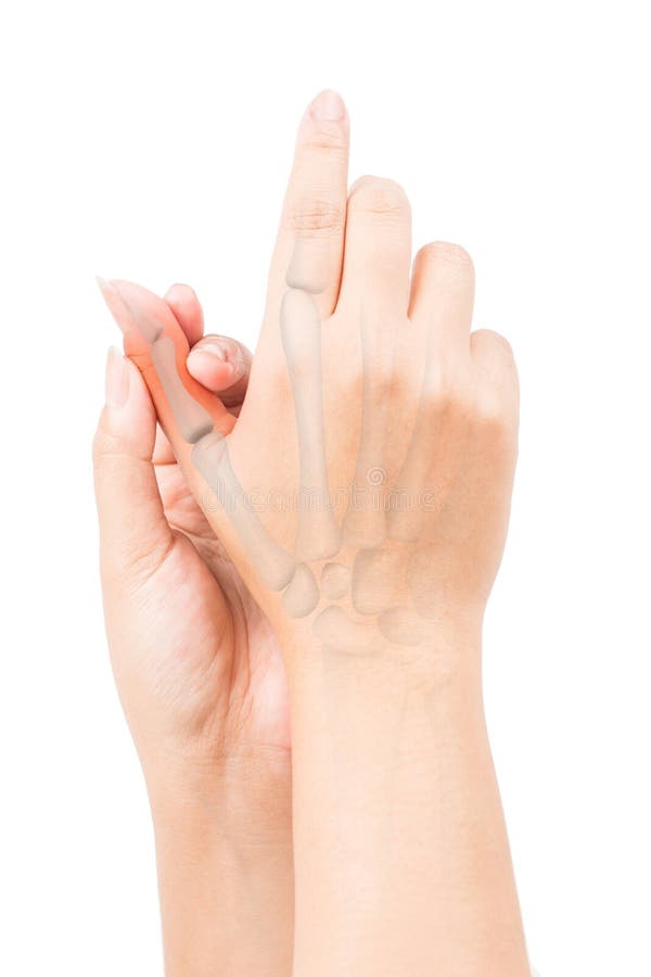 Finger bone pain stock image. Image of orthopedic, motion 81449633