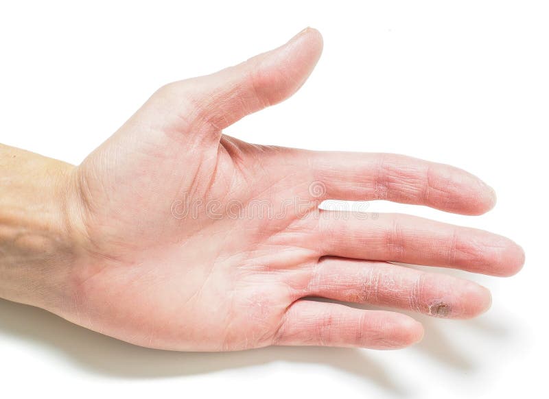 Finger med det infekterade snittet, förestående med torr hud arkivbild Finger med det infekterade snittet, förestående med torr hud arkivbild