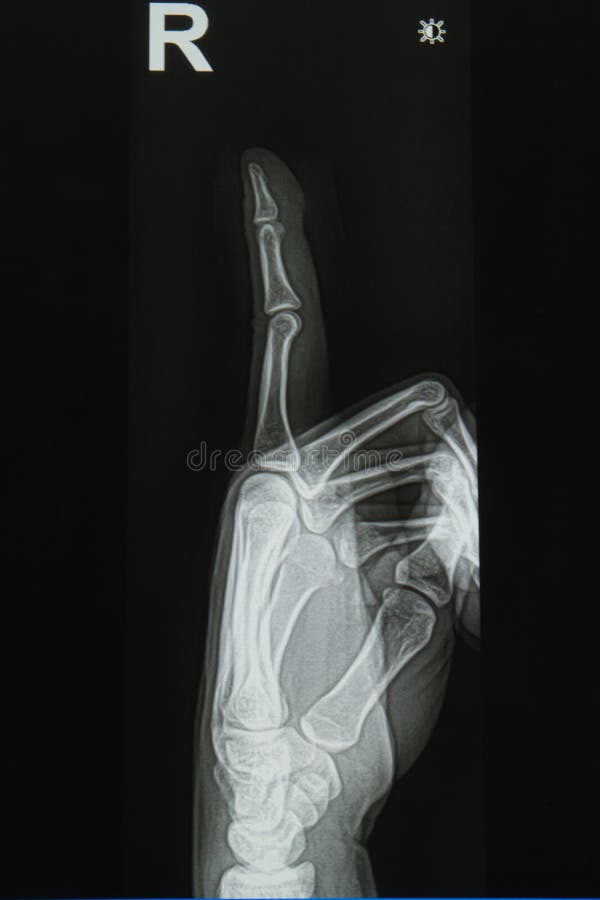 Patient Finger with Tubular Bandage Applicator Stock Image Image of recovery, protective 28852411