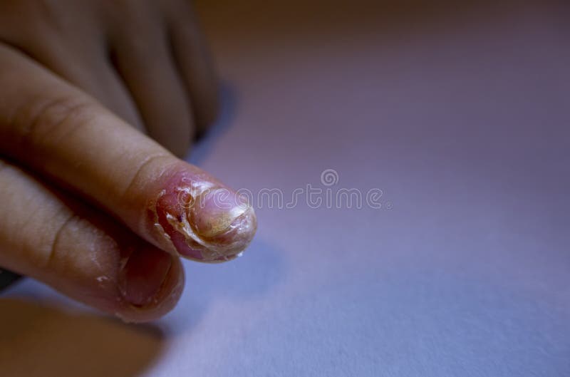 Swollen finger with gout - Stock Image - C009/5283 - Science Photo Library