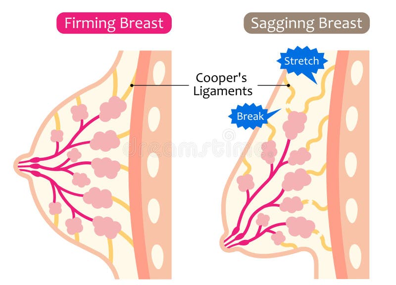 Diagram of Sagging Breasts and Womanâ€™s Body Illustration. Beauty