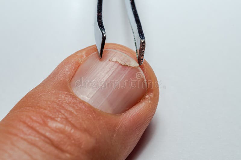 First Aid for a Patient with a Broken Fingernail Stock Photo Image of