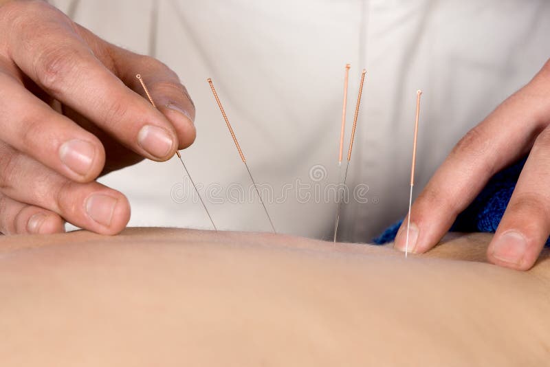 Fisioterapista che fa accupuncture immagini stock Fisioterapista che fa accupuncture immagini stock