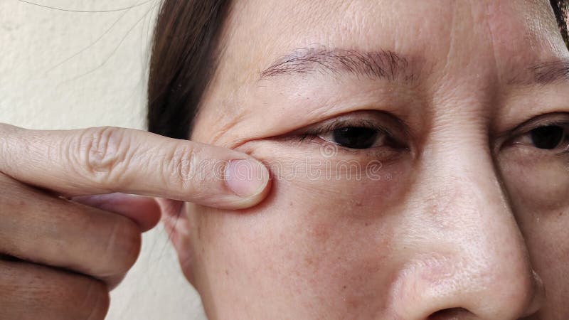 Portrait showing the flabbiness adipose sagging under the eye, ptosis and swelling beside the eyelid, forehead lines and freckles on the face, cellulite and bag under the eye, problem wrinkle and dullness of the woman, health care and beauty concept. Problem wrinkle stock images, royalty-free photos and pictures