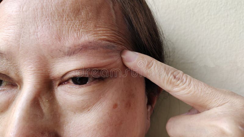 Portrait showing the flabbiness adipose sagging under the eye, ptosis and swelling beside the eyelid, forehead lines and freckles on the face, cellulite and bag under the eye, problem wrinkle and dullness of the woman, health care and beauty concept. Problem wrinkle stock images, royalty-free photos and pictures