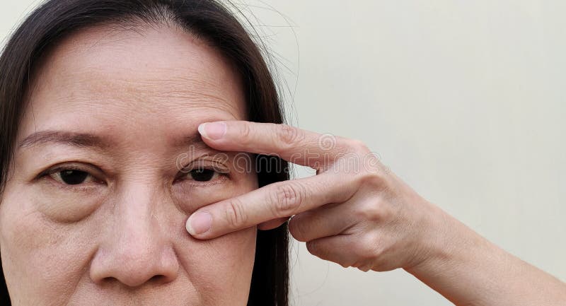 Portrait showing the flabbiness adipose sagging under the eyes, ptosis and swelling beside the eyelids, forehead lines and freckles on the face, cellulite and bag under the eyes, problem wrinkle and dullness of the woman, health care and beauty concept. Problem wrinkle stock images, royalty-free photos and pictures