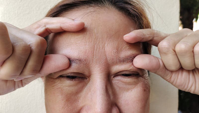 Portrait showing the flabbiness adipose sagging under the eye, ptosis and swelling beside the eyelid, forehead lines and freckles on the face, cellulite and bag under the eye, problem wrinkle and dullness of the woman, health care and beauty concept. Problem wrinkle stock images, royalty-free photos and pictures