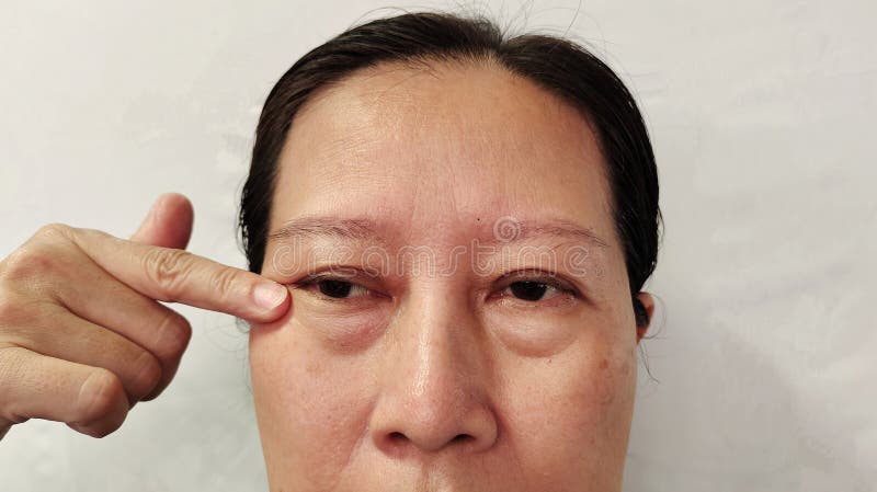 Portrait showing the flabbiness adipose sagging under the eyes, ptosis and swelling beside the eyelids, forehead lines and freckles on the face, cellulite and bag under the eyes, problem wrinkle and dullness of the woman, health care and beauty concept. Problem wrinkle stock images, royalty-free photos and pictures